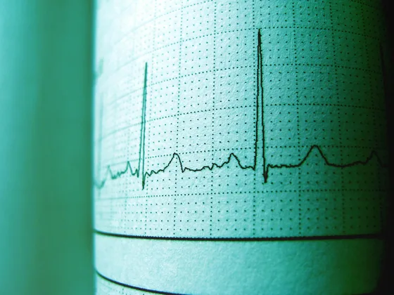EKG çıktısı kalp ritmi — atriyal fibrilasyon ve inme riski