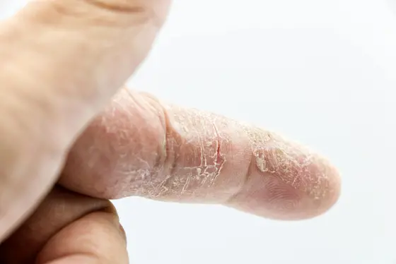 Yakın çekim cilt yüzey dokusu — dermatolojik durum