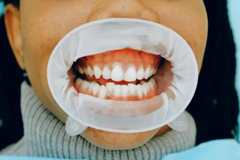 Diş muayenesi sırasında ağız — periodontoloji