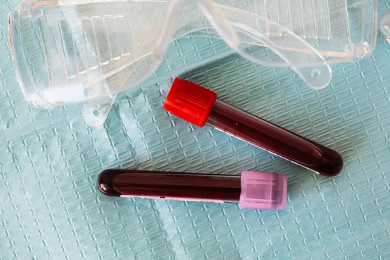 Karaciğer kan testi — Hepatit C