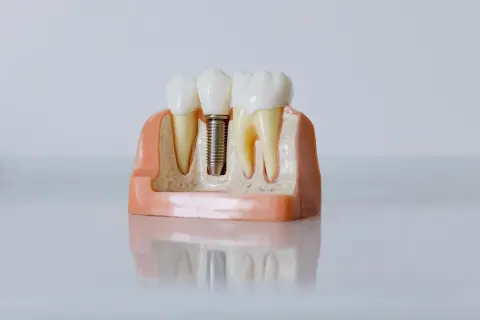 Diş implant modeli — protetik diş tedavisi