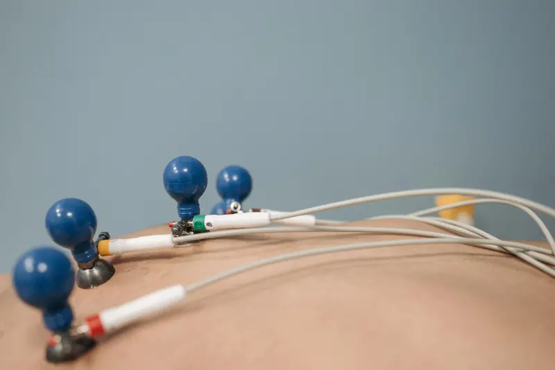 Egzersiz EKG'sinde V5 derivasyonunda ST segment depresyonu