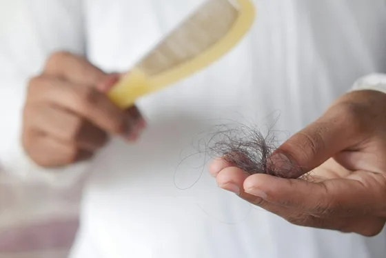 Saç dökülmesi — androgenetik alopesi